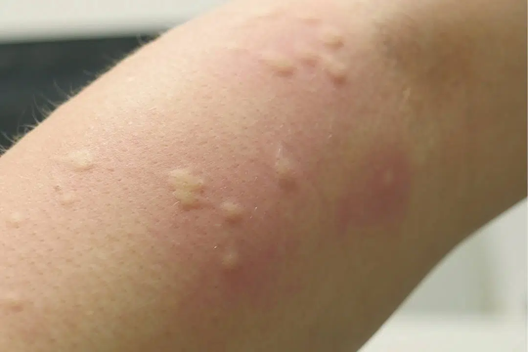 Käsi, jossa on hyttysen pistosten aiheuttamia paukamia.